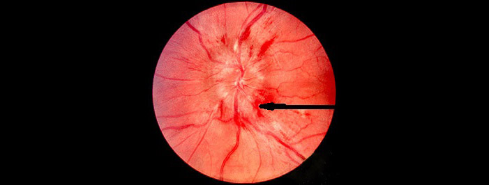 This clearly shows evidence of significant swelling in the optic disc with fundal haemorrhages.